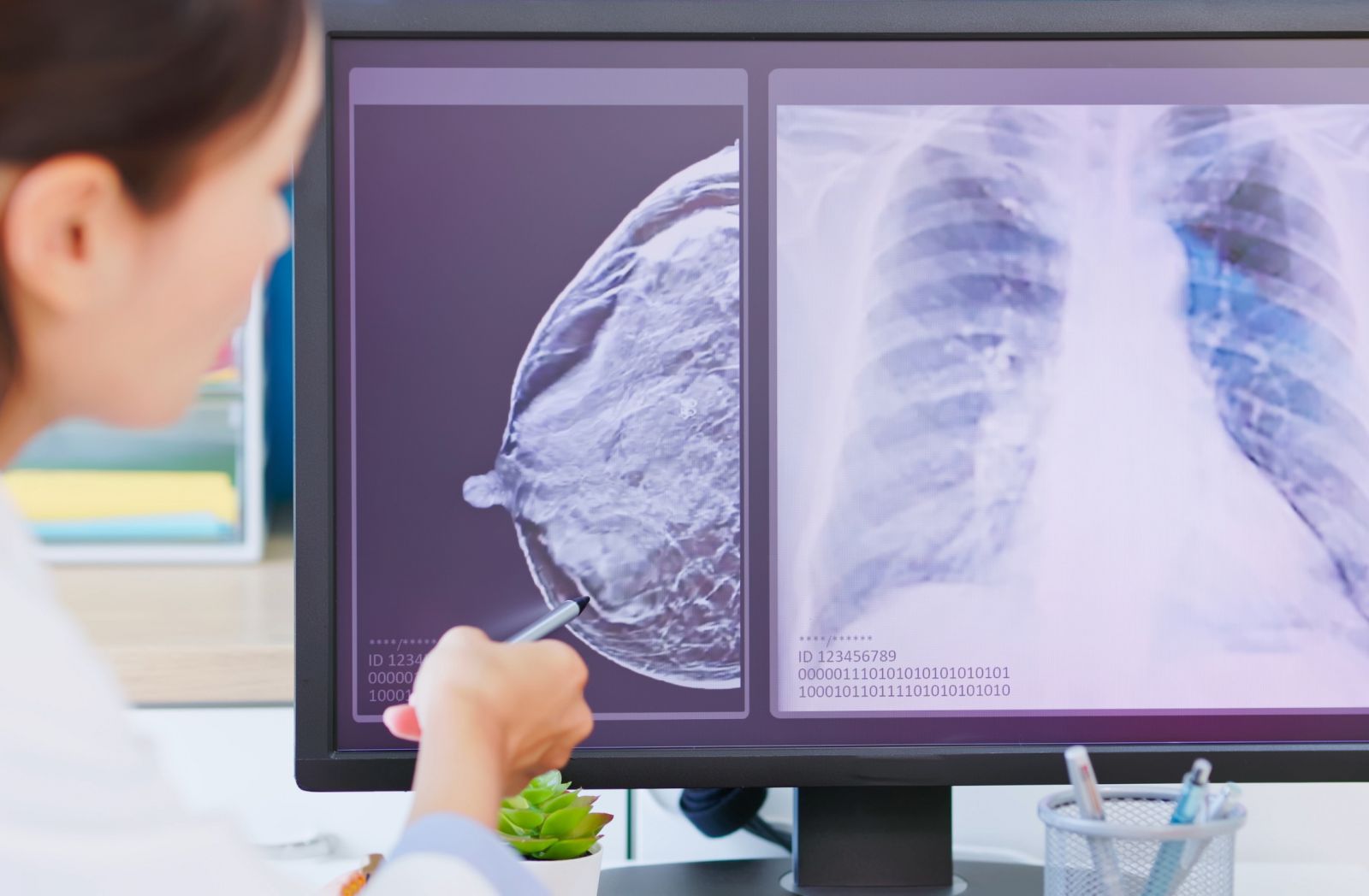 Ung thư vú di căn đến xương, phổi, gan và não