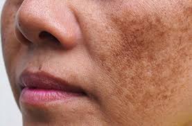 Hình ảnh phương pháp trị nám da mặt đơn giản khi bạn hiểu rõ về các loại nám