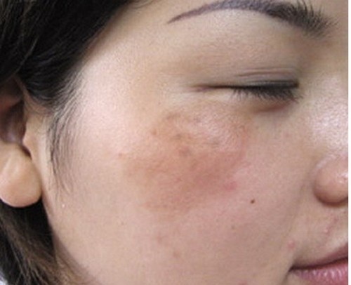 Hình ảnh có nên trị nám da mặt vào mùa hè không1