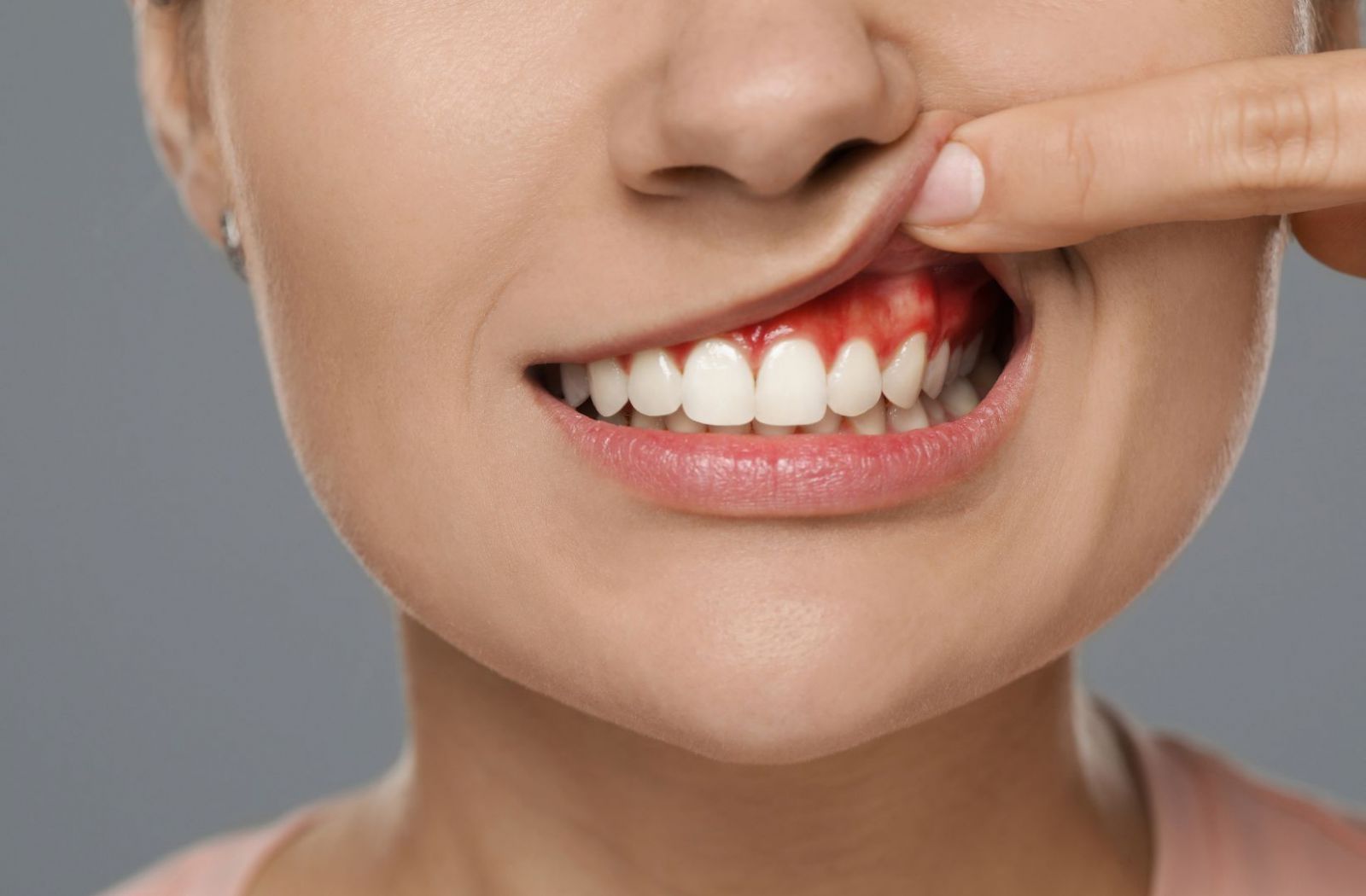 Nướu dễ nhạy cảm hơn