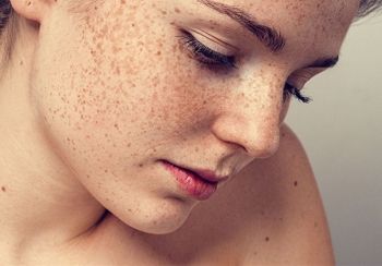 Hầu hết chị em trị nám không thành công là do sai lầm